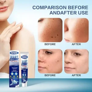 wart remover ointment